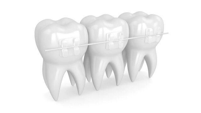 Teeth with clear orthodontic braces