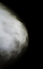 woman breast xray