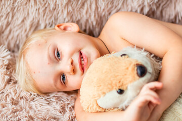 Little baby boy with Varicella virus or Chickenpox bubble rash.