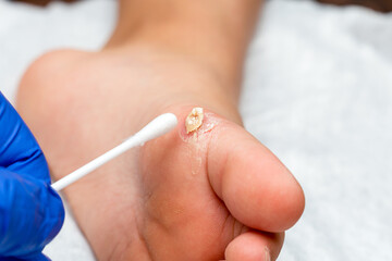 Healing treatment of cracked, dry wart, calluses on the child foot sole
