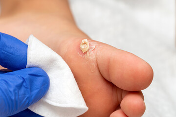 Healing treatment of cracked, dry wart, calluses on the child foot sole