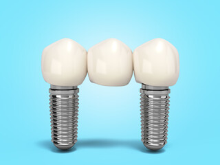 Tooth human bridge implant Dental concept Human teeth or dentures  multitooth 3d render on blue gradient