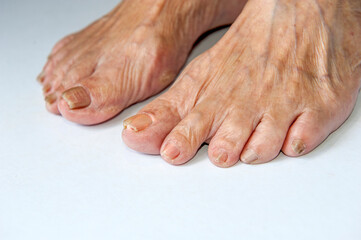 Closeup image of asian elderly foot Toe nail suffering from fungus infection on white background.
Selective focus.