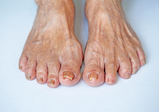 Closeup image of asian elderly foot Toe nail suffering from fungus infection on white background.
Selective focus.