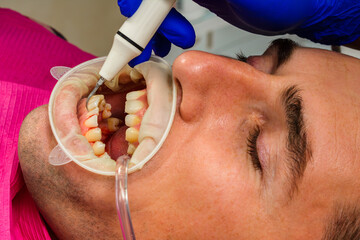 Dental practice, the dentist removes stones and hard plaque from the teeth with the help of...