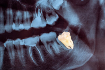 Dental panoramic x-ray. Medical concept. Dental treatment. Extraction of a wisdom tooth.