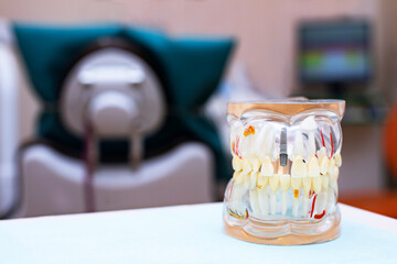Dentures in the office room, dentist. Prosthetics Jaw Model.