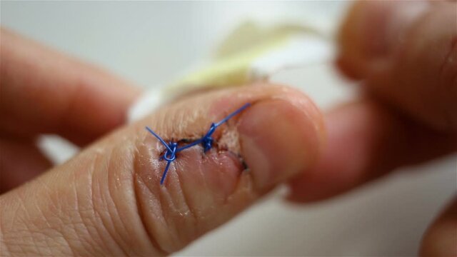 Peel off the band-aid from the skin. finger's. Contains people, wash, real time, natural light, medicine.
