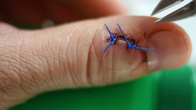 Attempt to cut the surgical suture line with wire cutters. Finger wound close-up, contains people, real time, natural light, medicine.