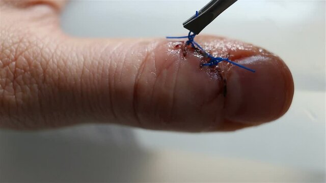 Remove surgical sutures with tweezers. Extreme close-up, real time, natural light, contains people, health, medicine