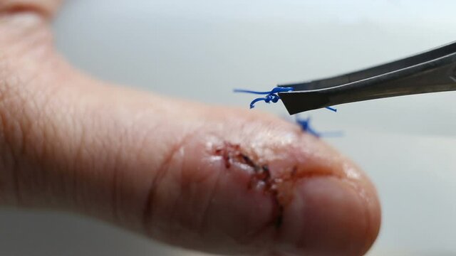 Removed the surgical suture on the forceps. Extreme close-up, real time, natural light, contains people, health, medicine