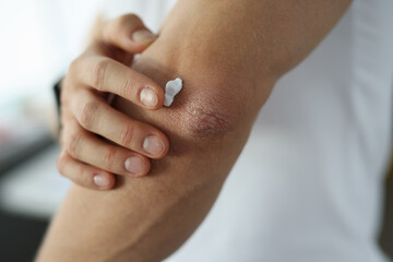 Man applying protective cream to damaged skin of elbow close-up. Psoriasis treatment concept - obrazy, fototapety, plakaty