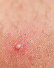 Infected ingrown hair with pus closeup view
