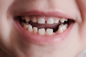 large mouth of a child without a tooth. First fallen tooth. The tooth fairy