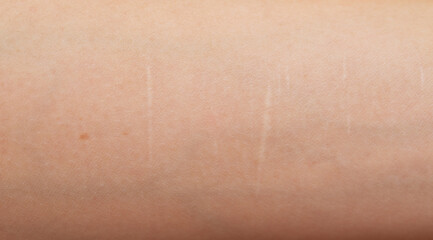 Fototapeta premium Hand with cuts