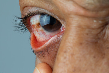 The asian young man has red eye inflammation,red eye, Conjunctivitis or irritation of sensitive...