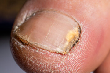 Fungus of nails on the big toe - dermatomycosis and onychomycosis, fungal infection macro photo....