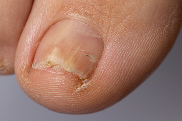 Fungus of nails on the big toe - dermatomycosis and onychomycosis, fungal infection macro photo....