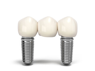Tooth human bridge implant Dental concept Human teeth or dentures  multitooth 3d render on white