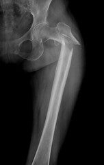 X-ray image of the  femur fracture in elderly women is the most common position in a fall accident.