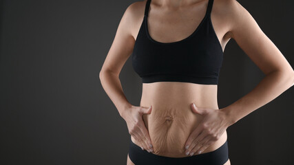 Woman showing stretch mark loose lower abdomen skin. Fat belly after pregnancy baby birth.Tummy...