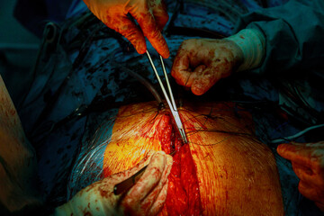 Surgeons suturing on sick patient after performing a serious surgery.