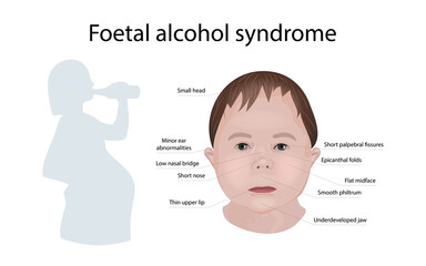 Illustration showing the effects of foetal alcohol syndrome on a child's face. With explanations. Drinking pregnant woman.