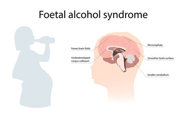 Illustration showing the effects of foetal alcohol syndrome on the brain. With explanations. Drinking pregnant woman.