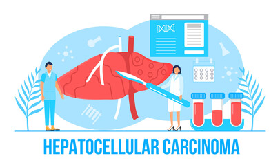 Hepatocellular carcinoma concept vector. Hepatitis A, B, C, D, cirrhosis, world hepatitis day. Tiny doctors treat liver