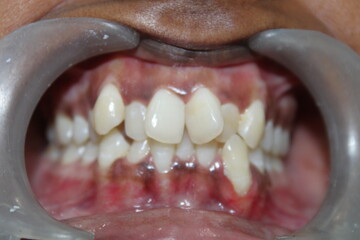 Malocclusion crowding teeth dentist