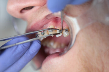 An orthodontist installs braces on the upper dentition of an adult patient. Correction of...