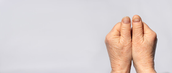 Nail fungus on the hands - dermatomicosis and onyhomicosis, comparison of healthy and sick nails....