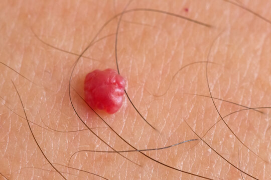 Senile angioma closeup macro view over caucasian skin