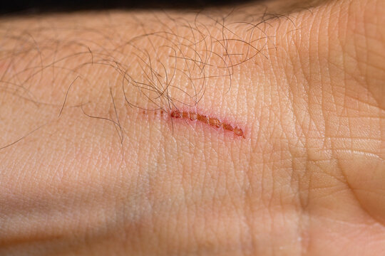 Scab over internal side of wrist closeup