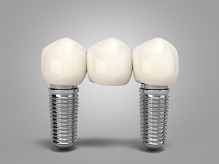 Tooth human bridge implant Dental concept Human teeth or dentures  multitooth 3d render on grey gradient