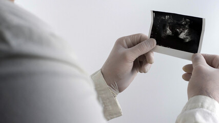 A shot of a male prostate in the hands of a doctor.