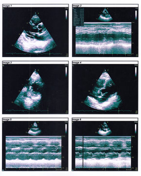 An echocardiography in 2d and M-Mode (TTE). Good ,  systolic function