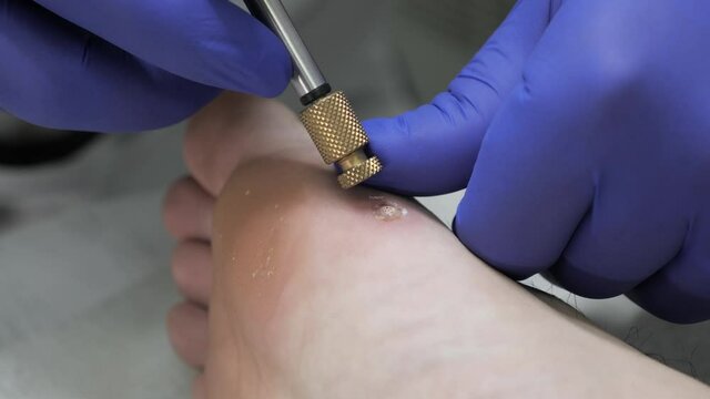 Podology Treatment of viral warts on the male foot in a cosmetology clinic.