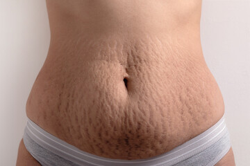 female belly with stretch marks - obrazy, fototapety, plakaty