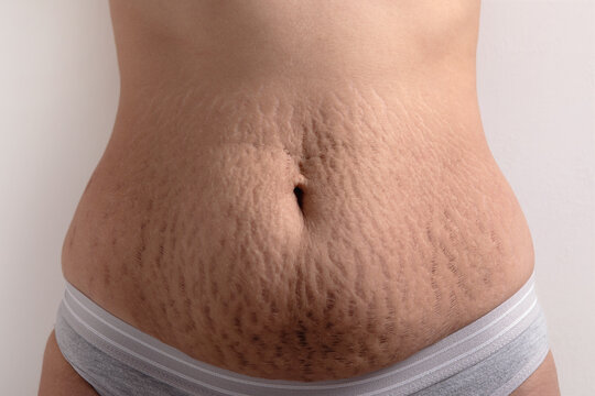 female belly with stretch marks
