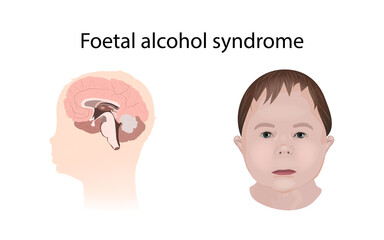 Illustration showing the effects of foetal alcohol syndrome on the brain and on a child's face.