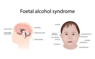 Illustration showing the effects of foetal alcohol syndrome on the brain and on a child's face. With explanations.