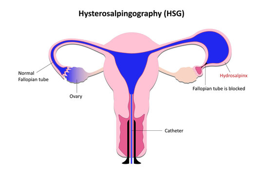 Hysterosalpingography, Radiological eamination of the uterine cavity and uterus
