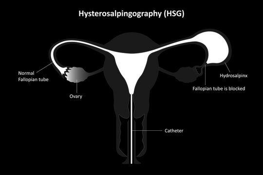 Hysterosalpingography, Radiological eamination of the uterine cavity and uterus