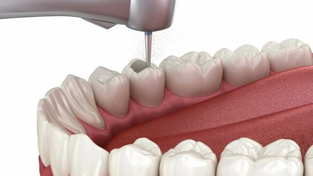 Endodontic root canal treatment process. Medically accurate tooth 3D animation