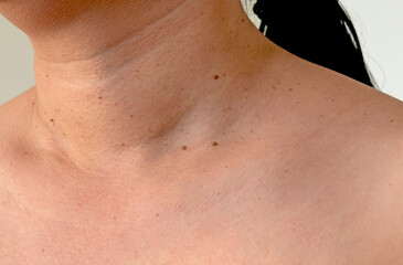 Close-up the skin tags on human skin, Asian woman middle age - obrazy, fototapety, plakaty