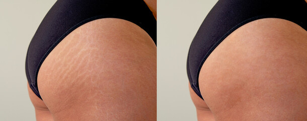 Image compare before and after Woman buttocks with stretch marks removal treatment, real people - obrazy, fototapety, plakaty