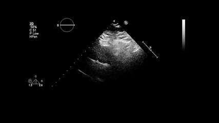 Image of the heart in gray-scale mode during transesophageal ultrasound.