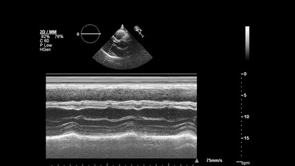 Image of the heart in gray-scale mode during transesophageal ultrasound.