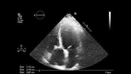 Image of the heart in gray-scale mode during transesophageal ultrasound.